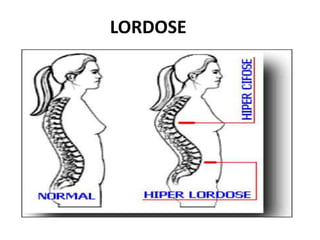 LORDOSE
 