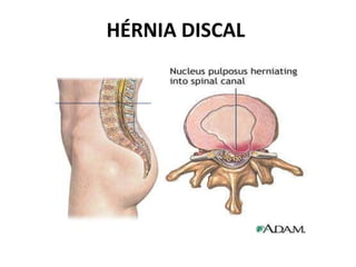 HÉRNIA DISCAL
 
