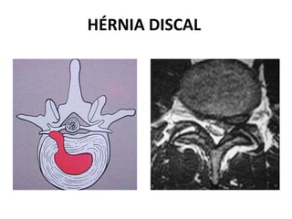 HÉRNIA DISCAL
 