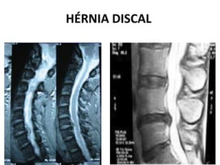 HÉRNIA DISCAL
 