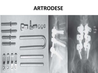 ARTRODESE
 