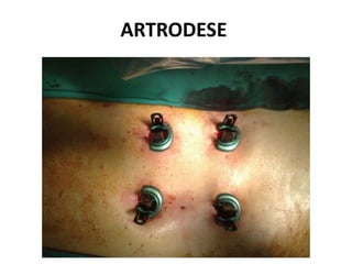 ARTRODESE
 