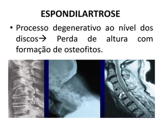 ESPONDILARTROSE
• Processo degenerativo ao nível dos
discos Perda de altura com
formação de osteofitos.
 