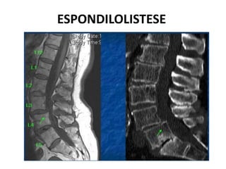 ESPONDILOLISTESE
 