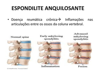 ESPONDILITE ANQUILOSANTE
• Doença reumática crônica Inflamações nas
articulações entre os ossos da coluna vertebral.
 