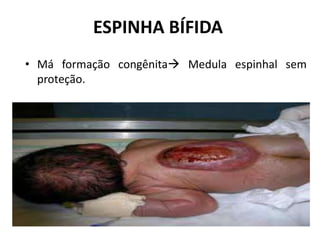 ESPINHA BÍFIDA
• Má formação congênita Medula espinhal sem
proteção.
 