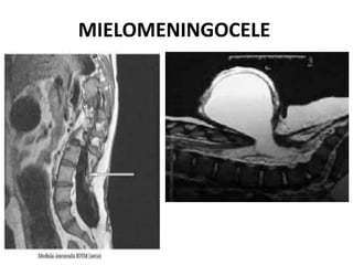 MIELOMENINGOCELE
 