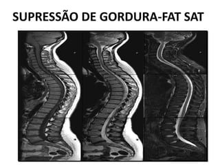 SUPRESSÃO DE GORDURA-FAT SAT
 