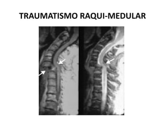 TRAUMATISMO RAQUI-MEDULAR
 