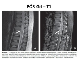 PÓS-Gd – T1
 