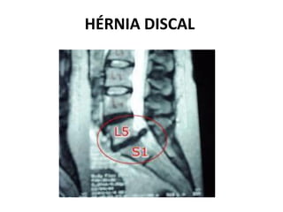 HÉRNIA DISCAL
 