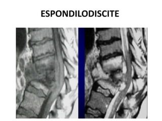 ESPONDILODISCITE
 
