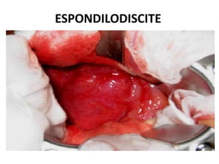 ESPONDILODISCITE
 