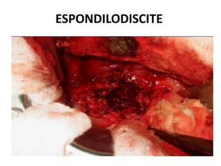 ESPONDILODISCITE
 