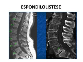 ESPONDILOLISTESE
 