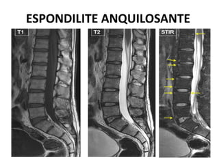 ESPONDILITE ANQUILOSANTE
 
