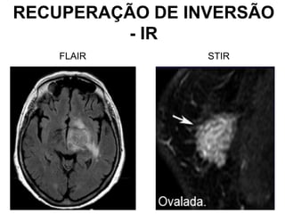 RECUPERAÇÃO DE INVERSÃO
- IR
FLAIR STIR
 