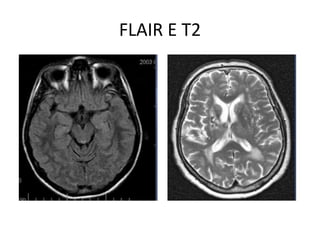 FLAIR E T2
 