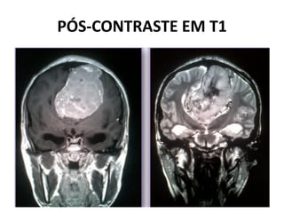 PÓS-CONTRASTE EM T1
 