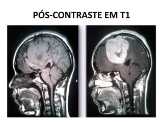 PÓS-CONTRASTE EM T1
 