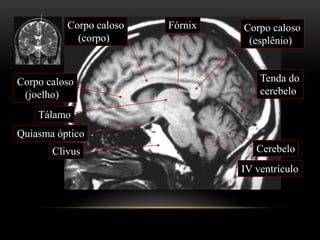 Corpo caloso
(corpo)
Quiasma óptico
IV ventrículo
Clivus Cerebelo
Corpo caloso
(esplênio)
Corpo caloso
(joelho)
Fórnix
Tenda do
cerebelo
Tálamo
 