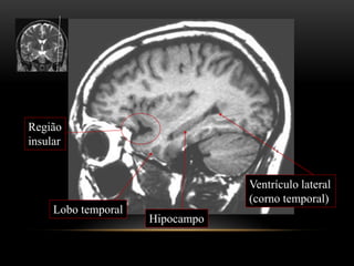 Hipocampo
Lobo temporal
Ventrículo lateral
(corno temporal)
Região
insular
 