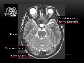 Ponte
Ventrículo lateral
(corno temporal)
Lobo occipital
Vermis cerebelar
 