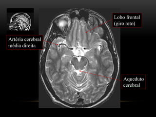 Artéria cerebral
média direita
Lobo frontal
(giro reto)
Aqueduto
cerebral
 