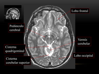 Cisterna
cerebelar superior
Pedúnculo
cerebral
Vermis
cerebelar
Lobo occipital
Lobo frontal
Cisterna
quadrigeminal
 