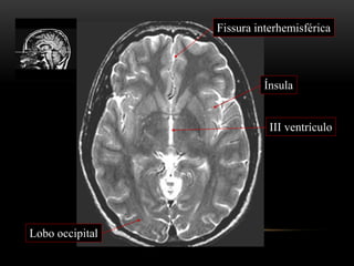 III ventrículo
Lobo occipital
Fissura interhemisférica
Ínsula
 