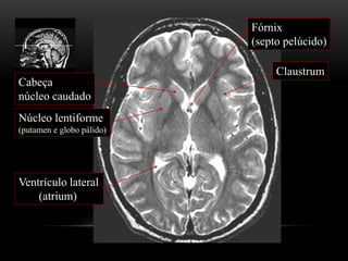 Cabeça
núcleo caudado
Núcleo lentiforme
(putamen e globo pálido)
Claustrum
Fórnix
(septo pelúcido)
Ventrículo lateral
(atrium)
 