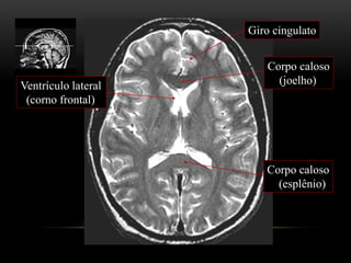 Ventrículo lateral
(corno frontal)
Corpo caloso
(joelho)
Corpo caloso
(esplênio)
Giro cingulato
 