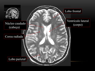Lobo parietal
Lobo frontal
Ventrículo lateral
(corpo)
Coroa radiada
Núcleo caudado
(cabeça)
 