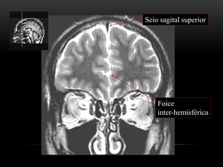 Foice
inter-hemisférica
Seio sagital superior
 