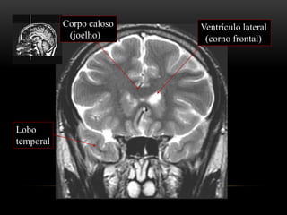 Corpo caloso
(joelho)
Ventrículo lateral
(corno frontal)
Lobo
temporal
 