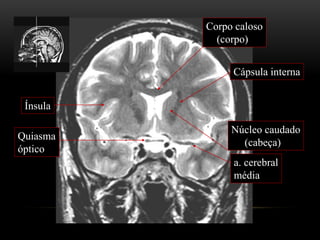 Corpo caloso
(corpo)
Quiasma
óptico
Cápsula interna
Núcleo caudado
(cabeça)
Ínsula
a. cerebral
média
 
