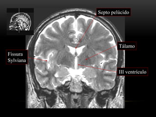 III ventrículo
Tálamo
Septo pelúcido
Fissura
Sylviana
 