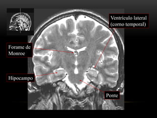 Hipocampo
Ventrículo lateral
(corno temporal)
Ponte
Forame de
Monroe
 
