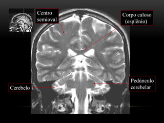 Pedúnculo
cerebelarCerebelo
Corpo caloso
(esplênio)
Centro
semioval
 