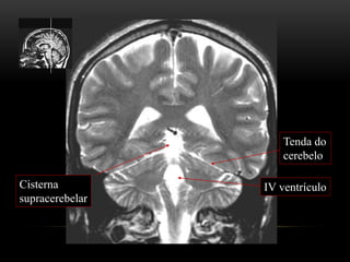 Tenda do
cerebelo
Cisterna
supracerebelar
IV ventrículo
 