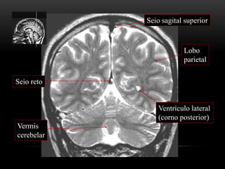 Vermis
cerebelar
Lobo
parietal
Seio reto
Seio sagital superior
Ventrículo lateral
(corno posterior)
 