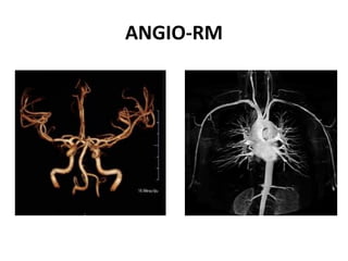 ANGIO-RM
 