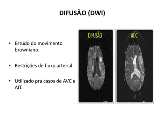 DIFUSÃO (DWI)
• Estudo do movimento
browniano.
• Restrições de fluxo arterial.
• Utilizado pra casos de AVC e
AIT.
 