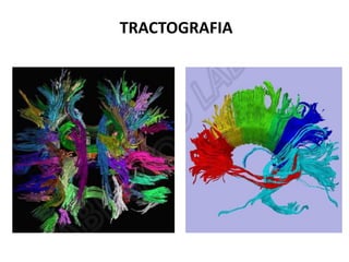 TRACTOGRAFIA
 