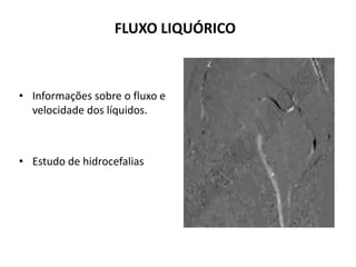 FLUXO LIQUÓRICO
• Informações sobre o fluxo e
velocidade dos líquidos.
• Estudo de hidrocefalias
 
