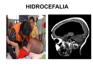 HIDROCEFALIA
 