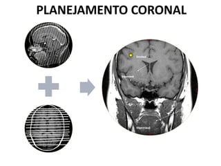 PLANEJAMENTO CORONAL
 