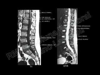RM da Coluna Vertebral