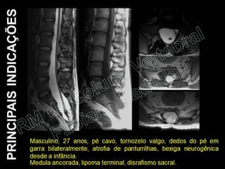 RM da Coluna Vertebral