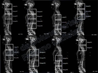 RM da Coluna Vertebral
